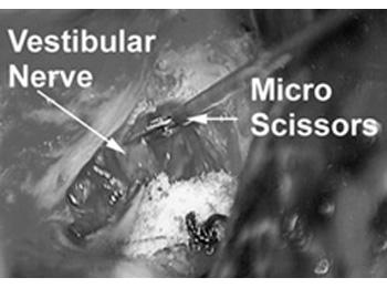 Figure 2: Vestibular nerve and micro scissors