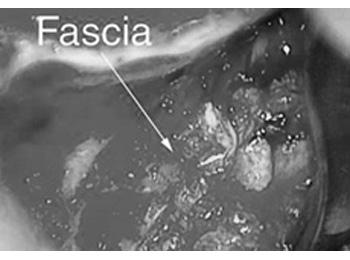 Figure 7: Fascia