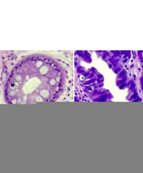 View of Barrett's dysplasia under the microscope