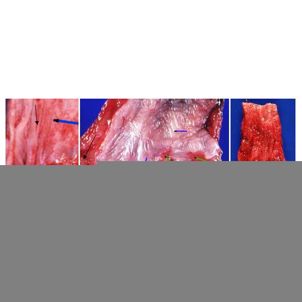 Barrett's Metaplasia and Cancer