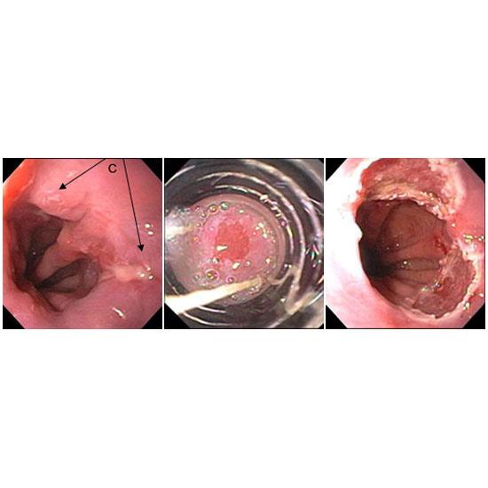 Figure A. Treatment options for Barrett's esophagus: Cryoablation and endoscopic mucosal resection