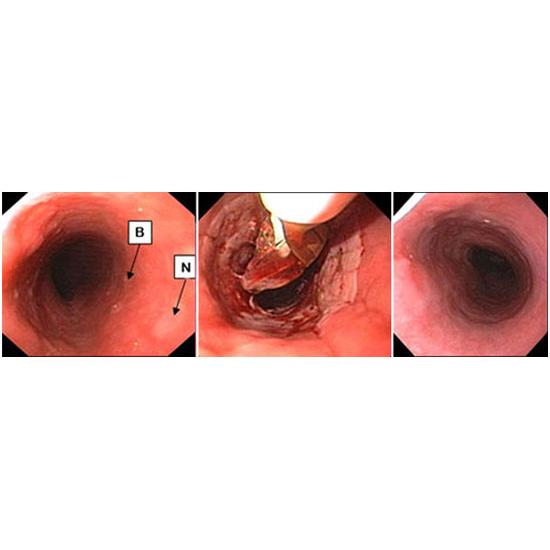 Figure B. Barrett's esophagus treatment options: Radio frequency ablation (BARRX)