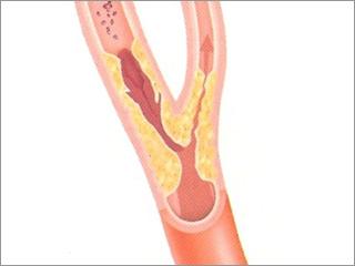 Figure 1. Carotid artery in the neck with stenosis