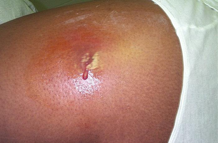 Methicillin Resistant Staphylococcus Aureus Mrsa