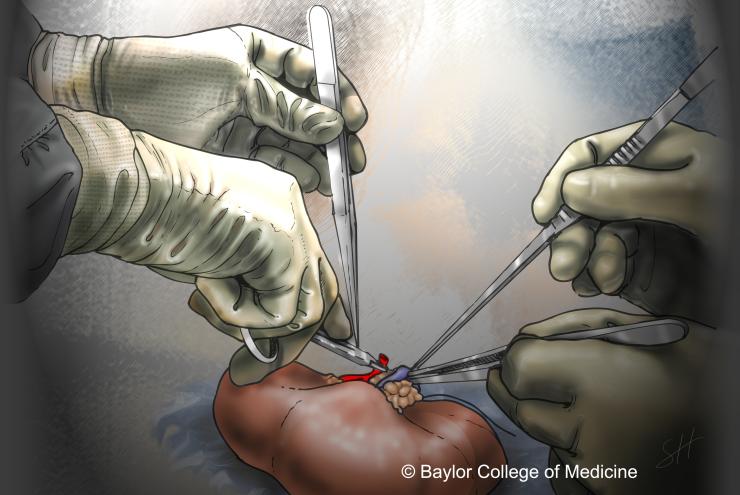 Bench or back-table operation of donor kidney.