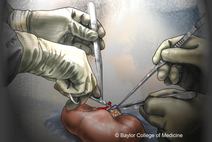 Bench or back-table operation of donor kidney.