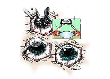 Illustration of a corneal transplantation