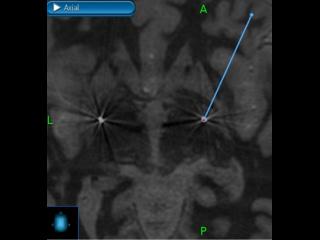 A CT scan is merged back to the planning MRI to check the electrode position before the patient leaves the operating room.