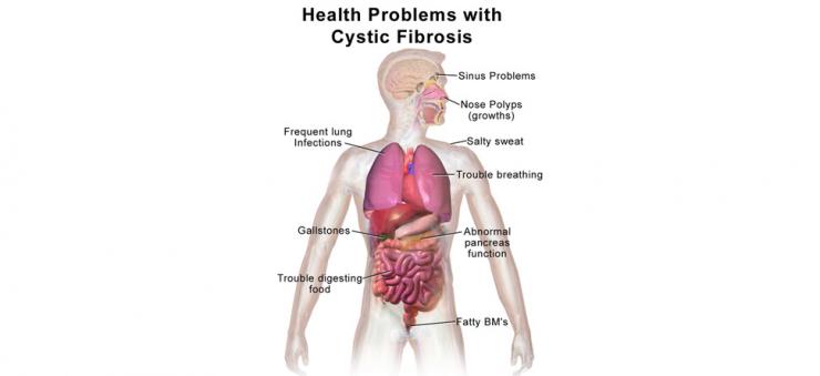 Health problems associated with CF include sinus problems, nose polyps, frequent lung infections, salty sweat, trouble breathing, gallstones, abnormal pancreas function, digestion problems, and fatty BM's.