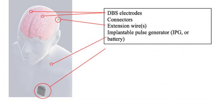 DBS Hardware
