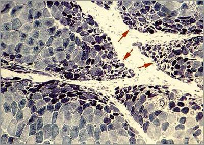 (Perifascicular atrophy) Muscle fibers at the periphery of the muscle fascicles are smaller than those in the center.