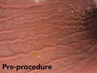 Endoscopic Sleeve Gastrectomy