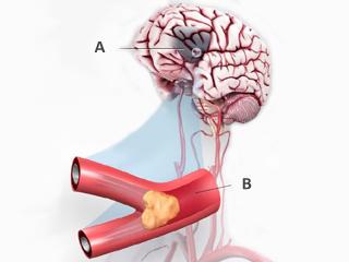 Figure 1. A blood clot breaks free, flows in the blood and lodges in a brain vessel. (A) Brain tissue affected by blockage. (B) Close-up of a clot inside an artery that provides blood flow to the brain.