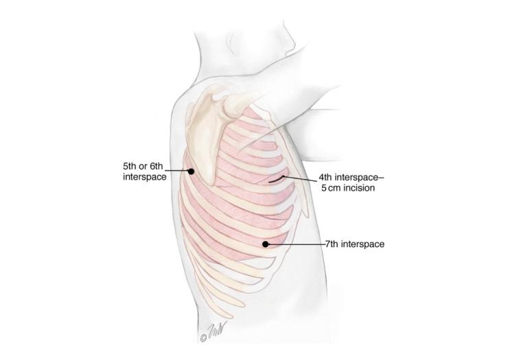 VATS Lobectomy thoracoscope sites.