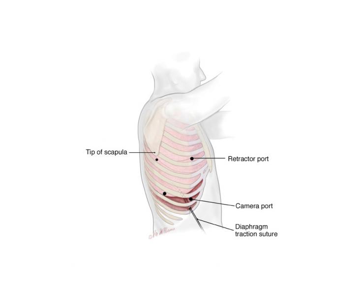Minimally Invasive Esophagectomy