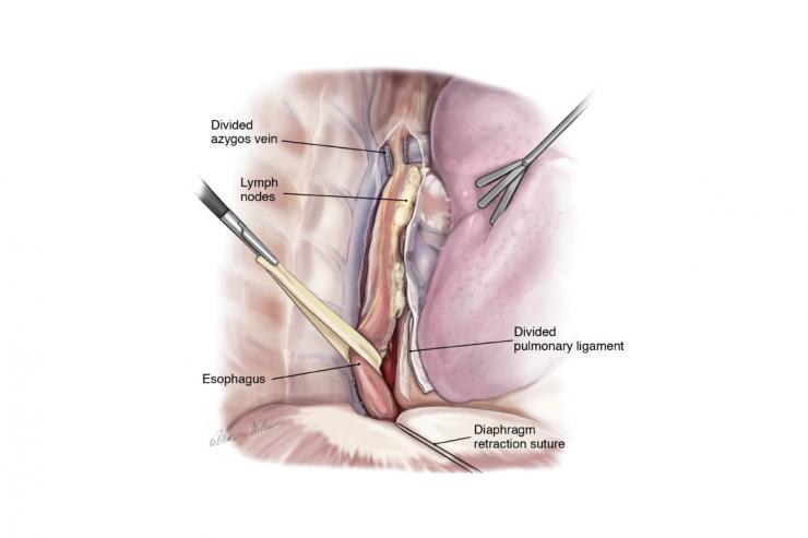 Esophagectomy