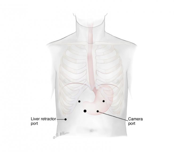 Minimally Invasive Esophagectomy Minimally Invasive Esophagectomy