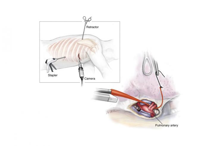 VATS lobectomy procedure