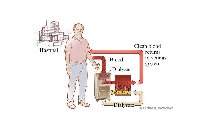 Dialysis