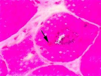 Eosinophilic inclusions