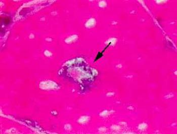 Rimmed vacuole