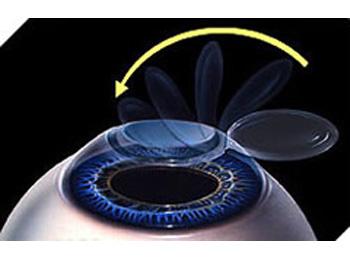 Lasik - advantages