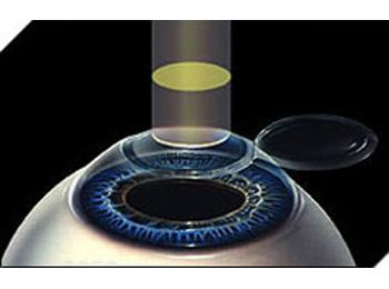 Lasik Surgery