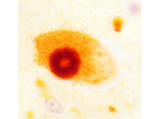 The Lewy body is the pathological hallmark of Parkinson's disease. Photo courtesy of Dr. Mel B. Feany.