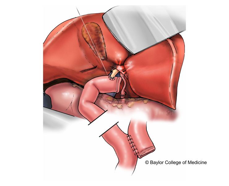 Liver transplant with revised bile duct anastomosis.