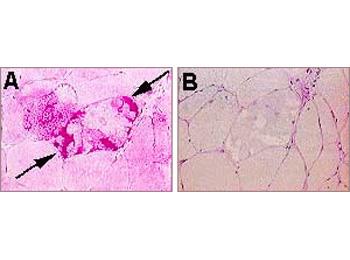 Vacuoles containing PAS-positive material (A) digested by diastase (B)