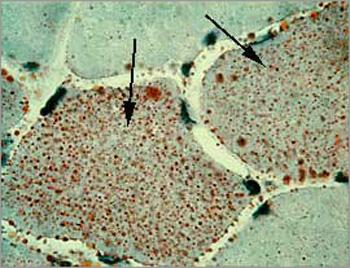 Oil-red-O stain showing increased number of lipid droplets