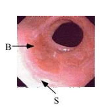 View of Barrett's metaplasia through an endoscope
