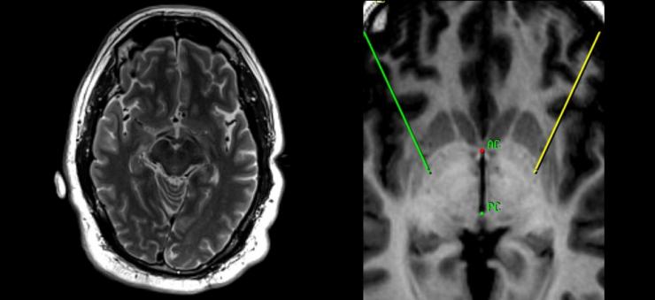 Left: A preoperative brain MRI scan such as this helps the surgical team place the electrodes in the best location. Right: A preoperative brain MRI is used to help plan the surgical trajectory.