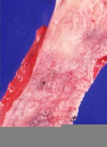 Normal esophagus