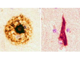 Amyloid plaques (left) and Neurofibrillary tangles (right) are the pathological lesions of Alzheimer's disease. Photo Courtesy of Dr. Mel B. Feany.