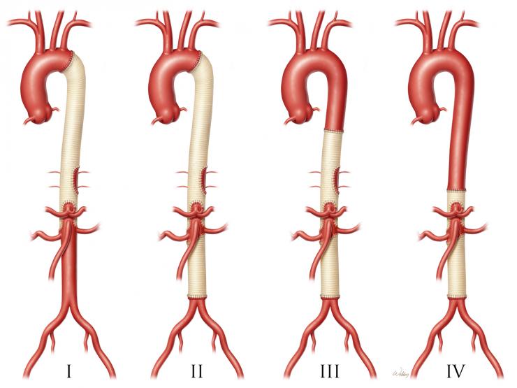 The Crawford extents of thoracoabdominal aortic aneurysm (TAAA) repair. Illustration by Scott A. Weldon, MA, CMI. Copyright, Baylor College of Medicine.