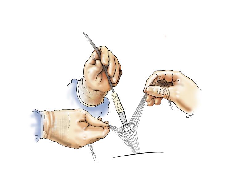 Mitral valve annuloplast ring placement.