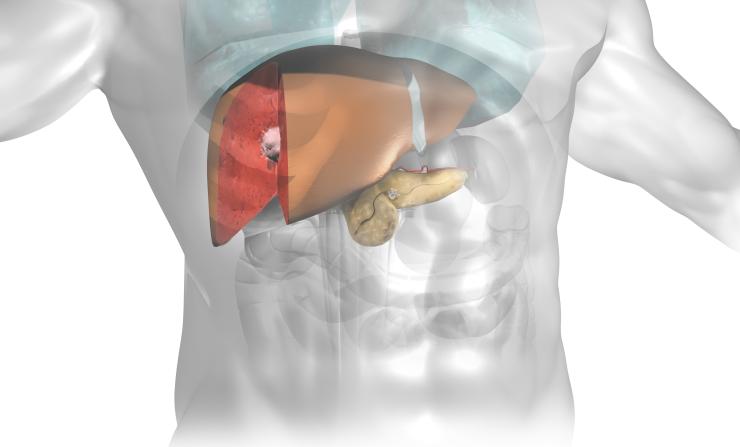 Liver and Pancreas tumors