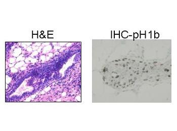 Estrogen Receptors in Breast Cancer Progression