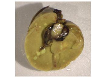 Estrogen Receptors in Breast Cancer Progression