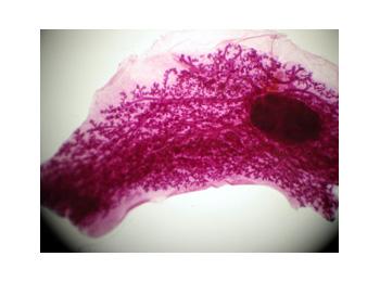 Estrogen Receptors in Breast Cancer Progression