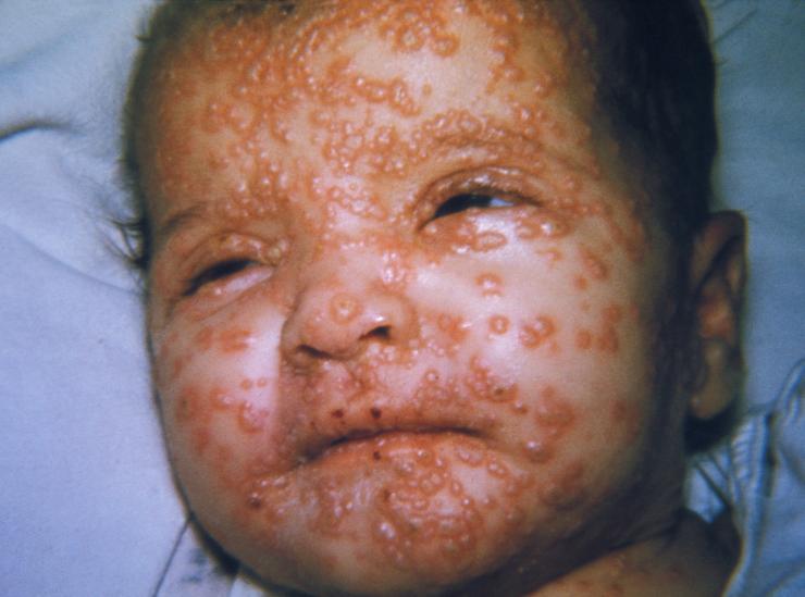 Early smallpox pustules on the face of an infant.