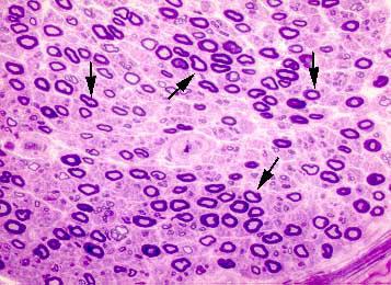Semi-thin section of a sural nerve of a 25-year-old patient with neuropathy showing a mild reduction in the number of nerve fibers (arrows).