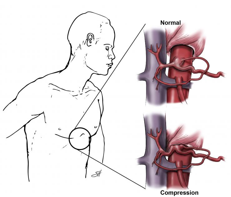 Celiac Compression Syndrome. Illustration by Scott Holmes, C.M.I.