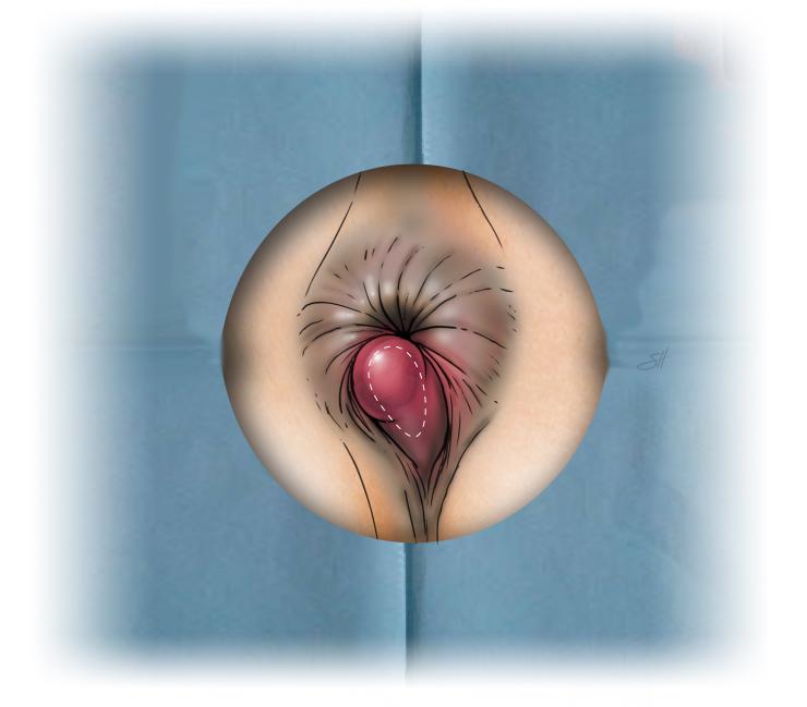 Thrombosed external hemorrhoid repair