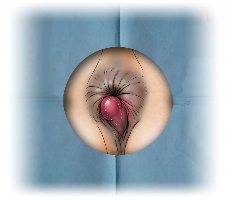 Thrombosed external hemorrhoid repair