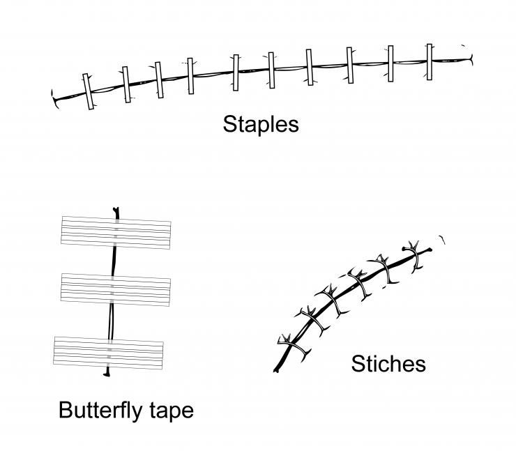 Types of wound closures. Illustration by Scott Holmes