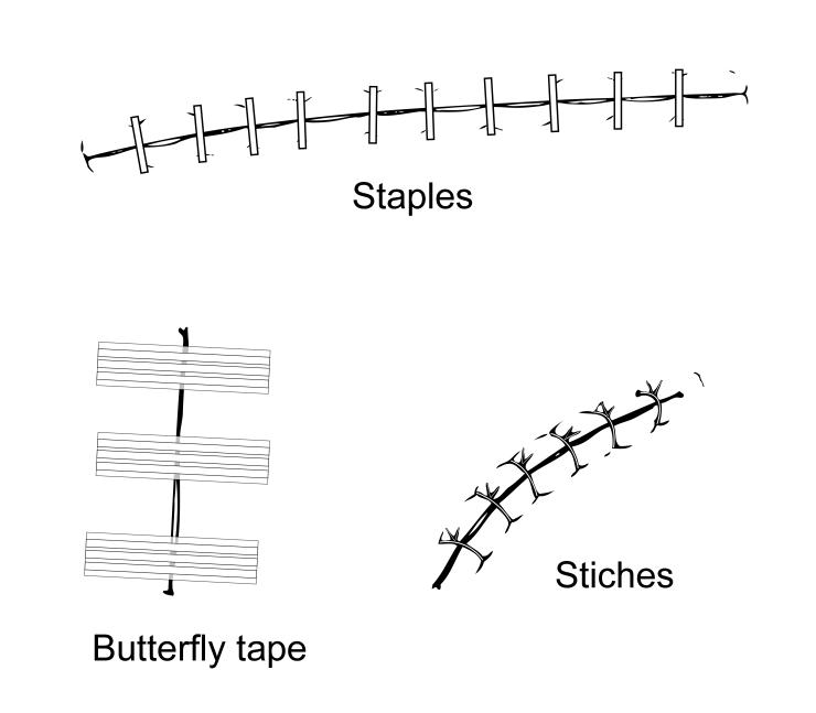 Types of wound closures. Illustration by Scott Holmes