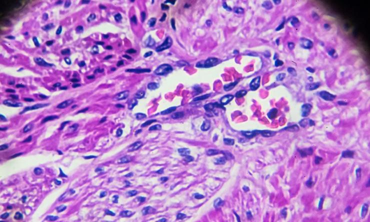 Carcinoma cells under the microscope