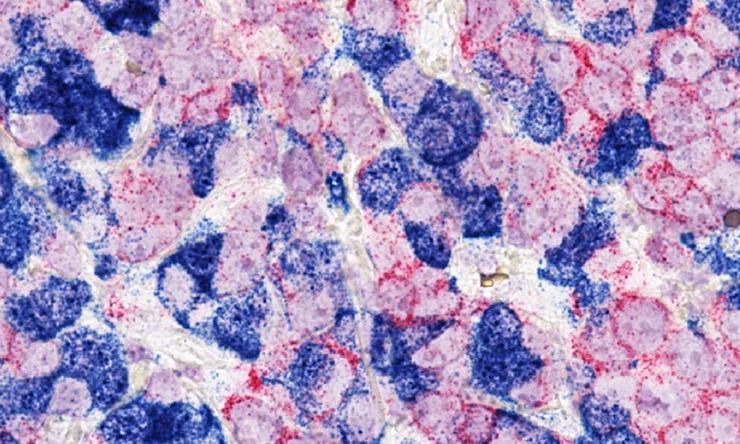 Human breast cancer cells with two different tracers (red and blue) to investigate the interaction of tumor cells.